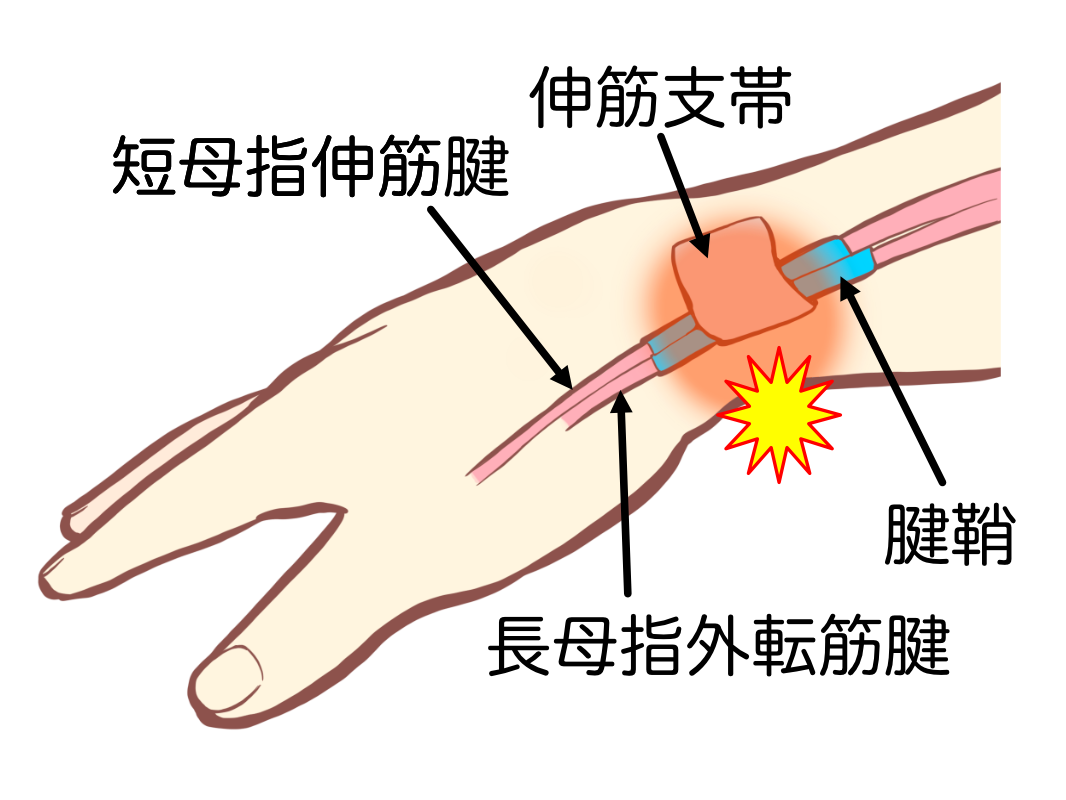 手首の親指側に起こる腱鞘炎の位置を示した図