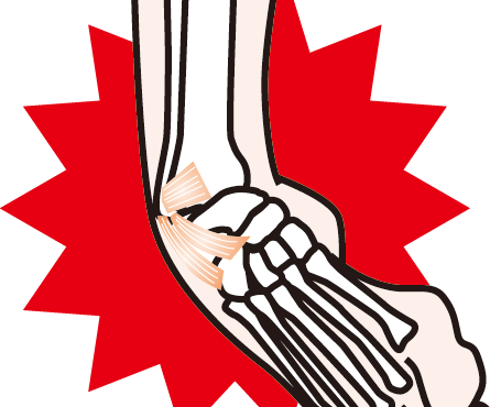 捻挫を早期改善に導く