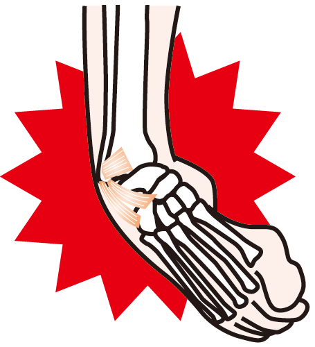 【捻挫】固定しないから回復が早い！