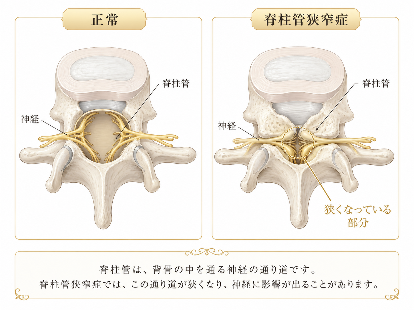 正常な脊柱管と脊柱管狭窄症の違いを示したイメージ図